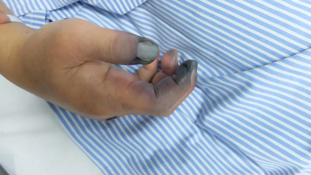 ما هي الغرغرينا؟ الأسباب والأعراض وطرق العلاج الفعالة