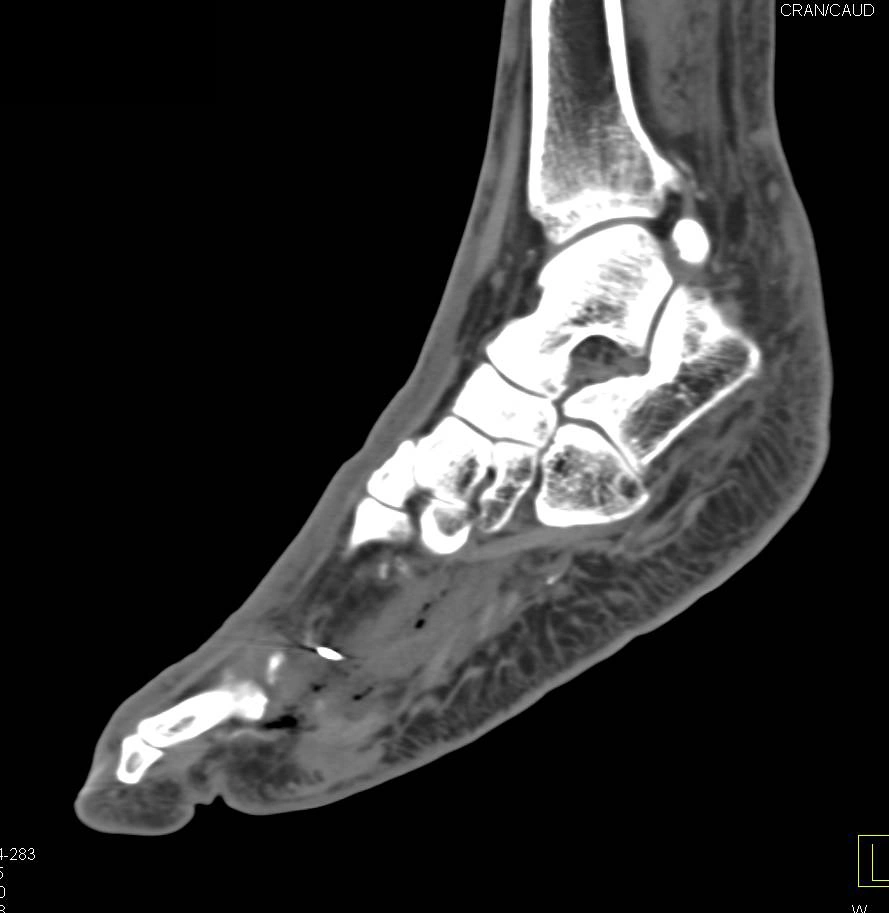 أشعة للغرغرينا الغازية في القدم