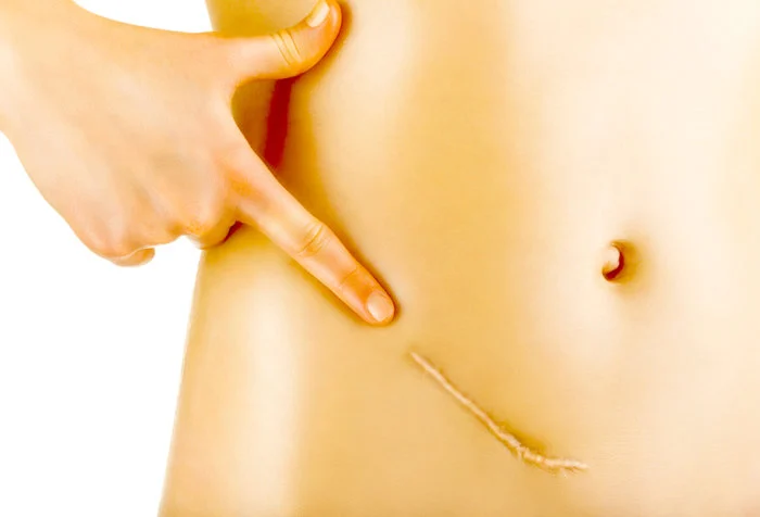 إزالة الزائدة بعملية بطن مفتوح