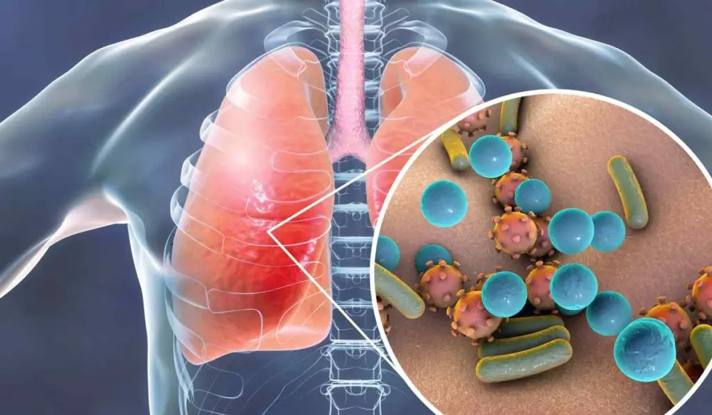 الالتهاب الرئوي: الأسباب والأعراض وطرق العلاج والوقاية