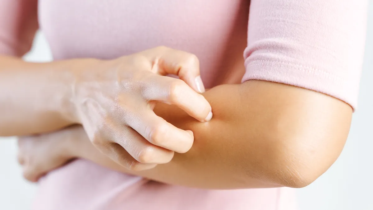 العلاقة بين الأرتكاريا والحالة النفسية: هل التوتر والقلق يسببان الشرى؟