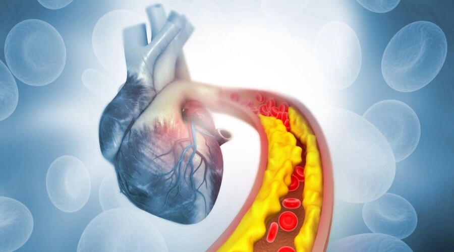 ارتفاع الكوليسترول: الأسباب والأعراض وطرق خفضه بفعالية