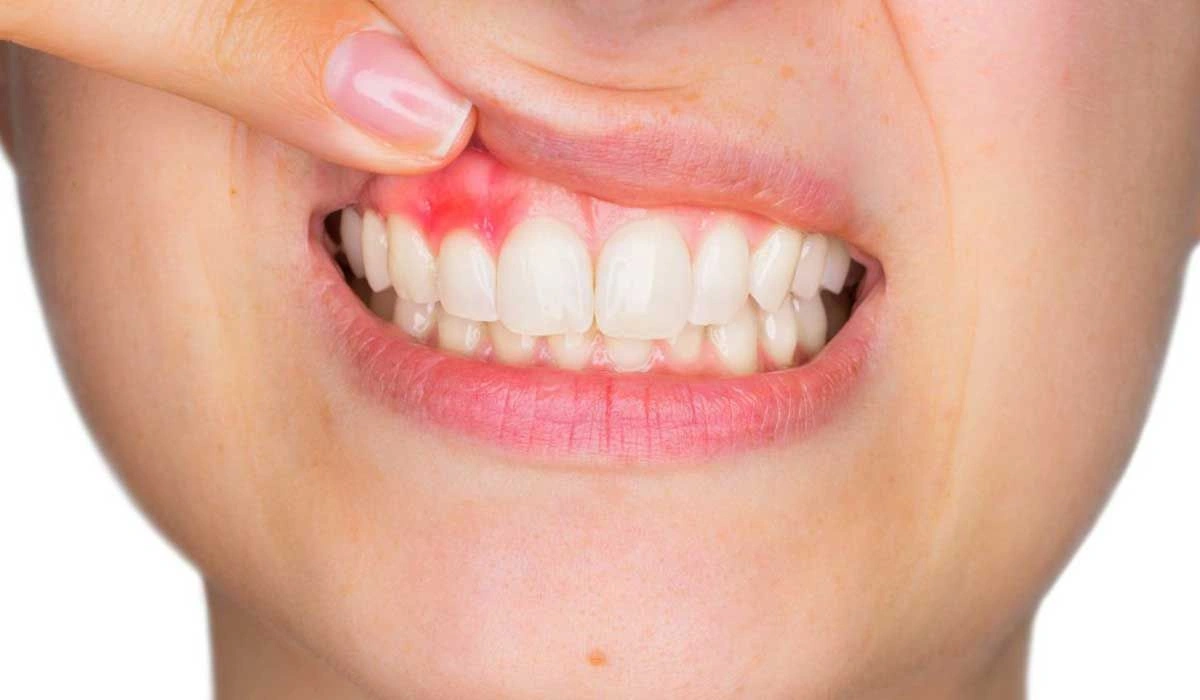 التهاب اللثة