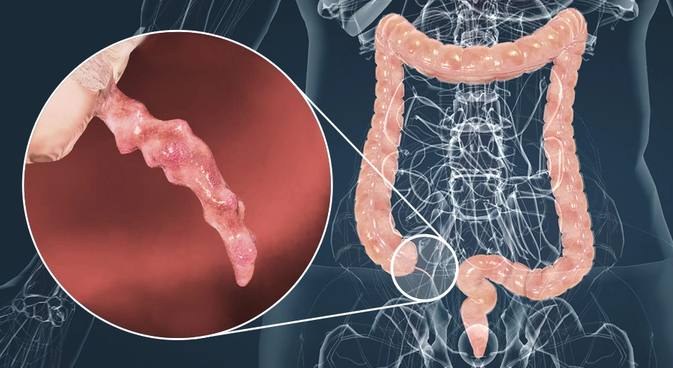 الزائدة الدودية: ما هي؟ وما وظائفها وفوائدها الصحية للجسم؟