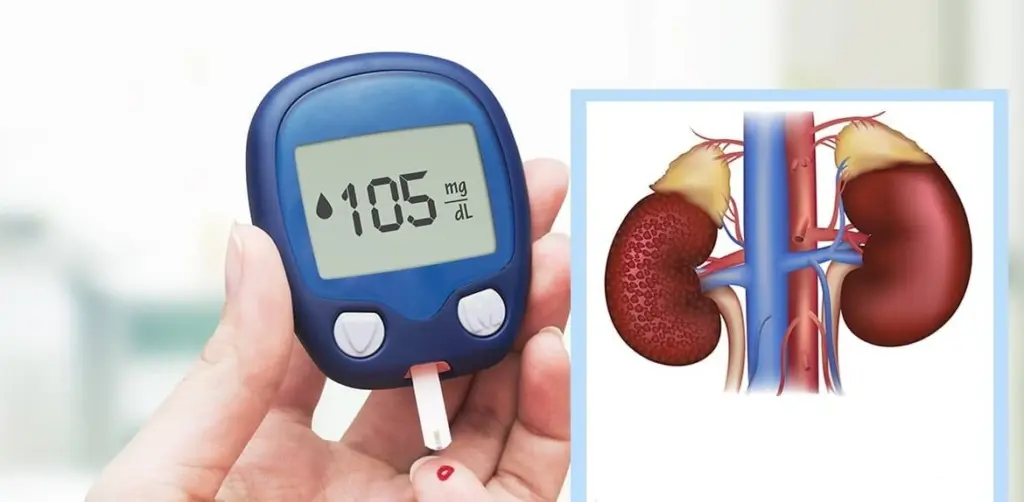 تأثير السكر على الكلى: كيف يحمي مريض السكري كليتيه من التلف؟