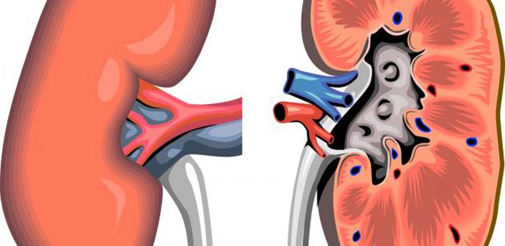 الفشل الكلوي