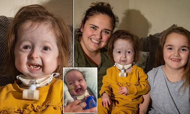 متلازمة بروجيريا