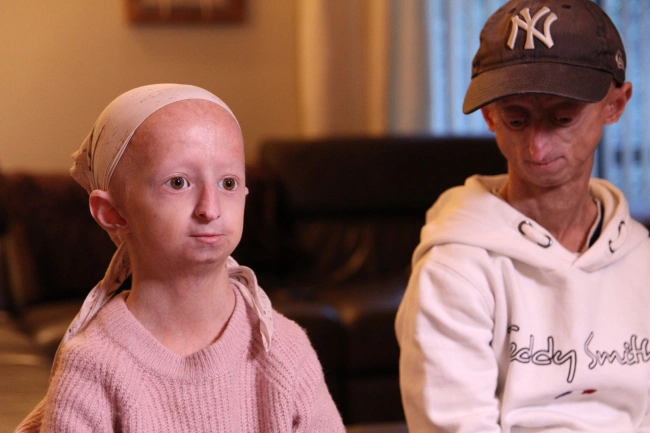 أطفال مصابون بمرض الشيخوخة المبكرة