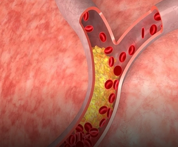 تراكم الدهون على جدران الشرايين