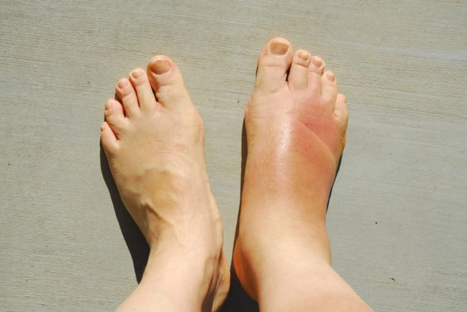تورم القدمين من أعراض تأثير السكر على الكلى