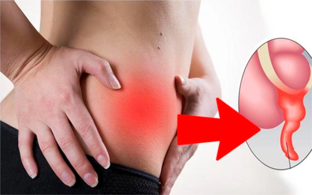 ما هو التهاب الزائدة الدودية؟