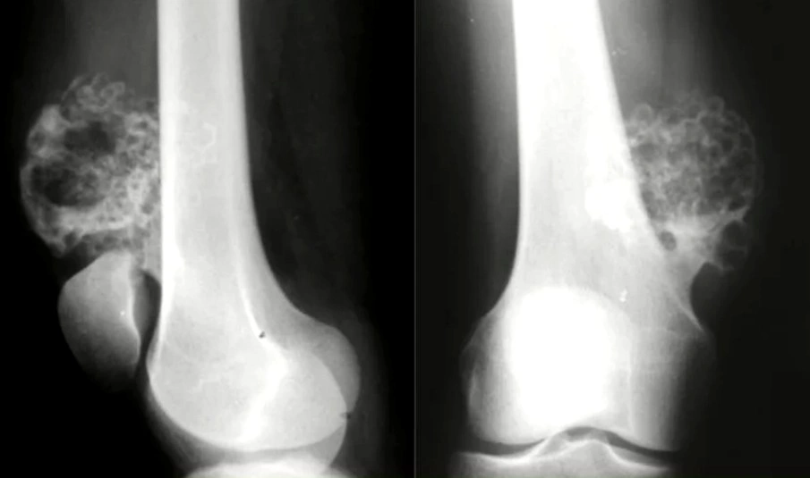 ورم سرطاني في العظام