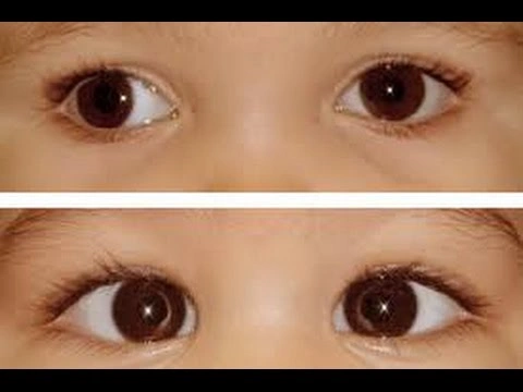 أنواع حول العين عند الأطفال