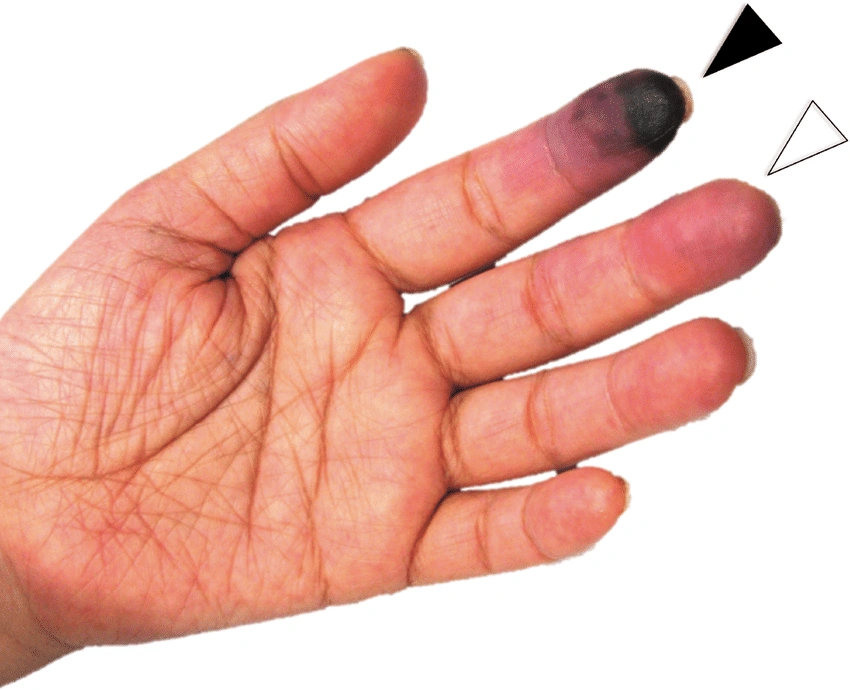 غرغرينا بالأصابع