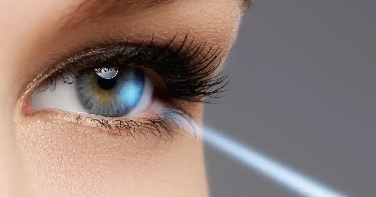 تصحيح النظر بالليزر