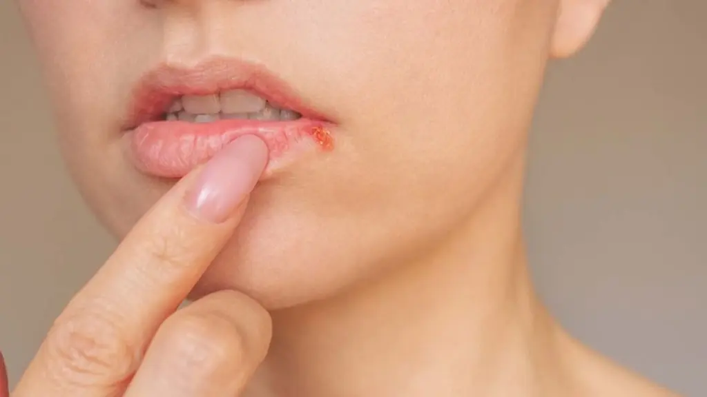 مرض الهربس الجلدي..هل هو معدٍ؟ أسباب الإصابة والأعراض وطرق العلاج