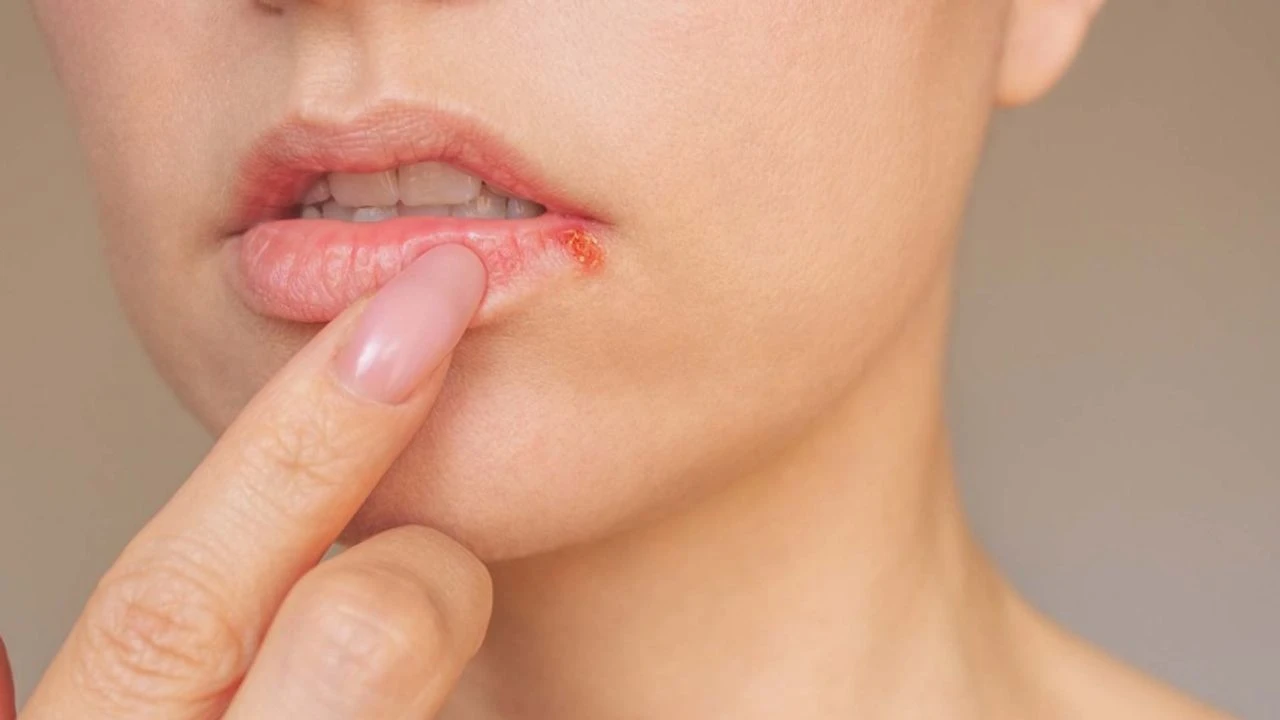 مرض الهربس الجلدي..هل هو معدٍ؟ أسباب الإصابة والأعراض وطرق العلاج