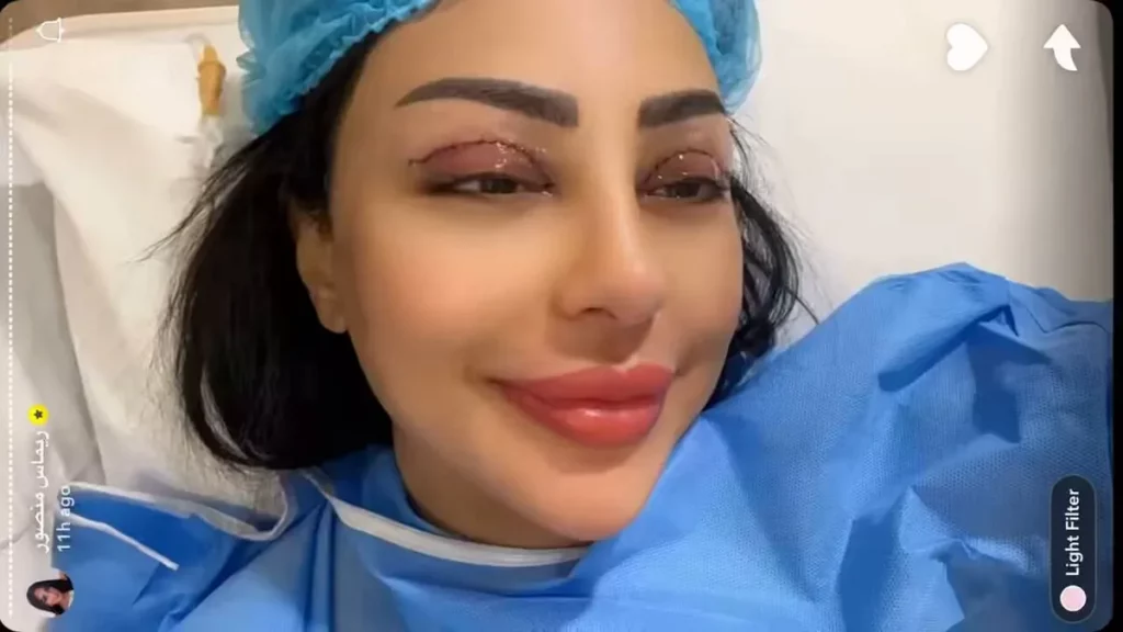 خضوع ريماس منصور لعملية الجفن المبطن
