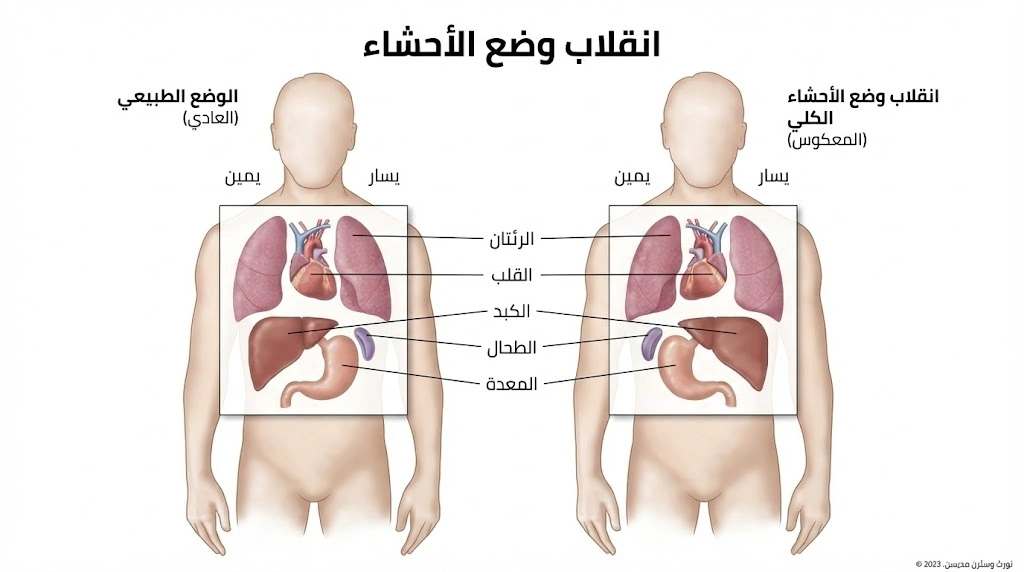 مرض كاثرين أوهارا انعكاس وضع الأعضاء أو انعكاس الأحشاء (بالإنجليزية: Situs inversus)
